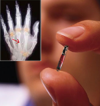RFID Chip in hand